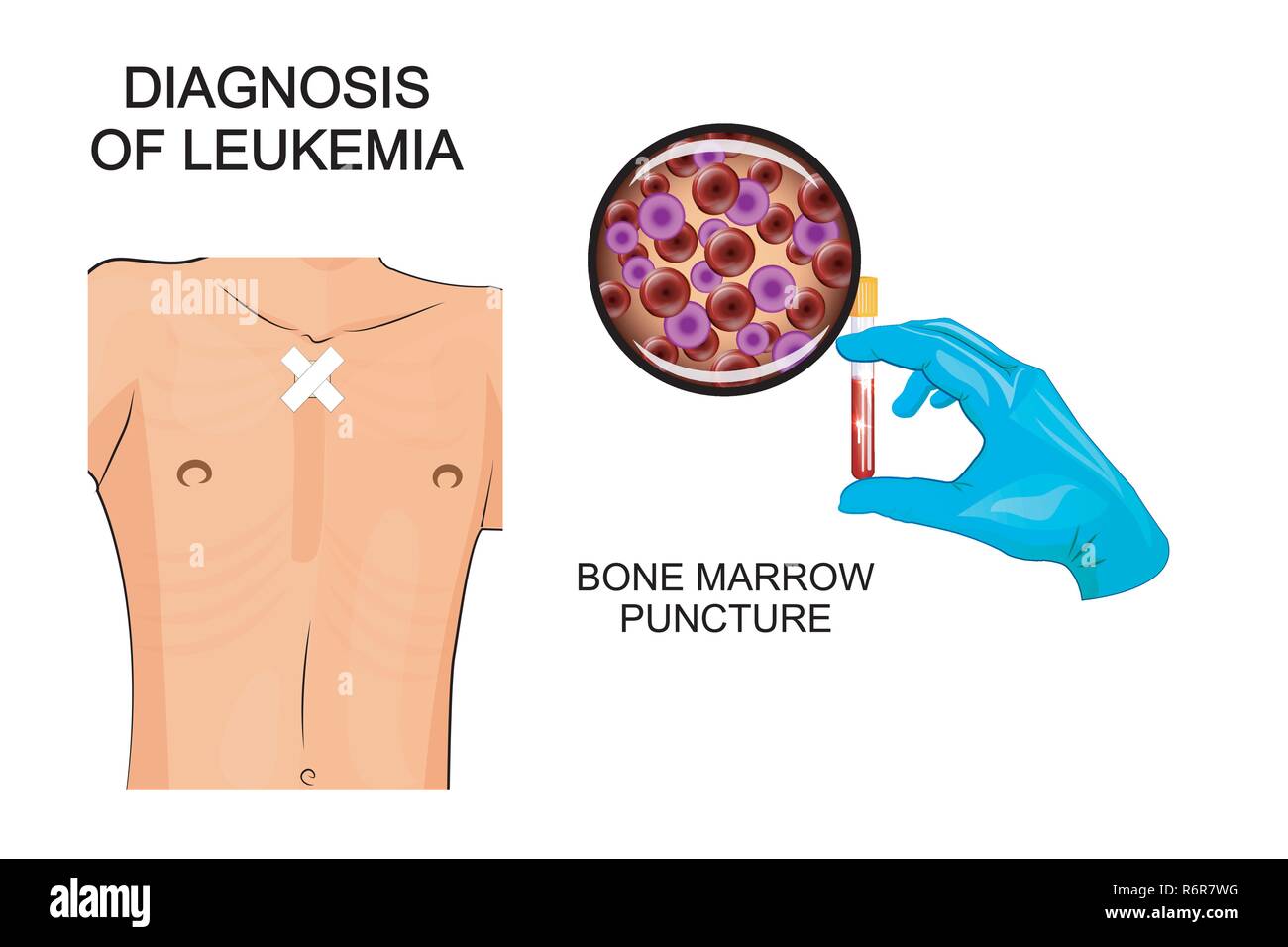 Illustrazione della diagnosi di leucemia. Midollo osseo foratura Illustrazione Vettoriale