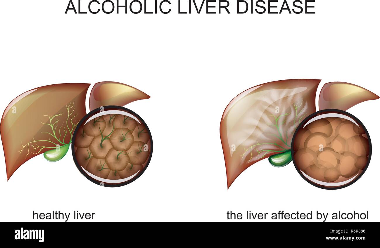 Illustrazione di un fegato sano e cirrosi alcolica Illustrazione Vettoriale
