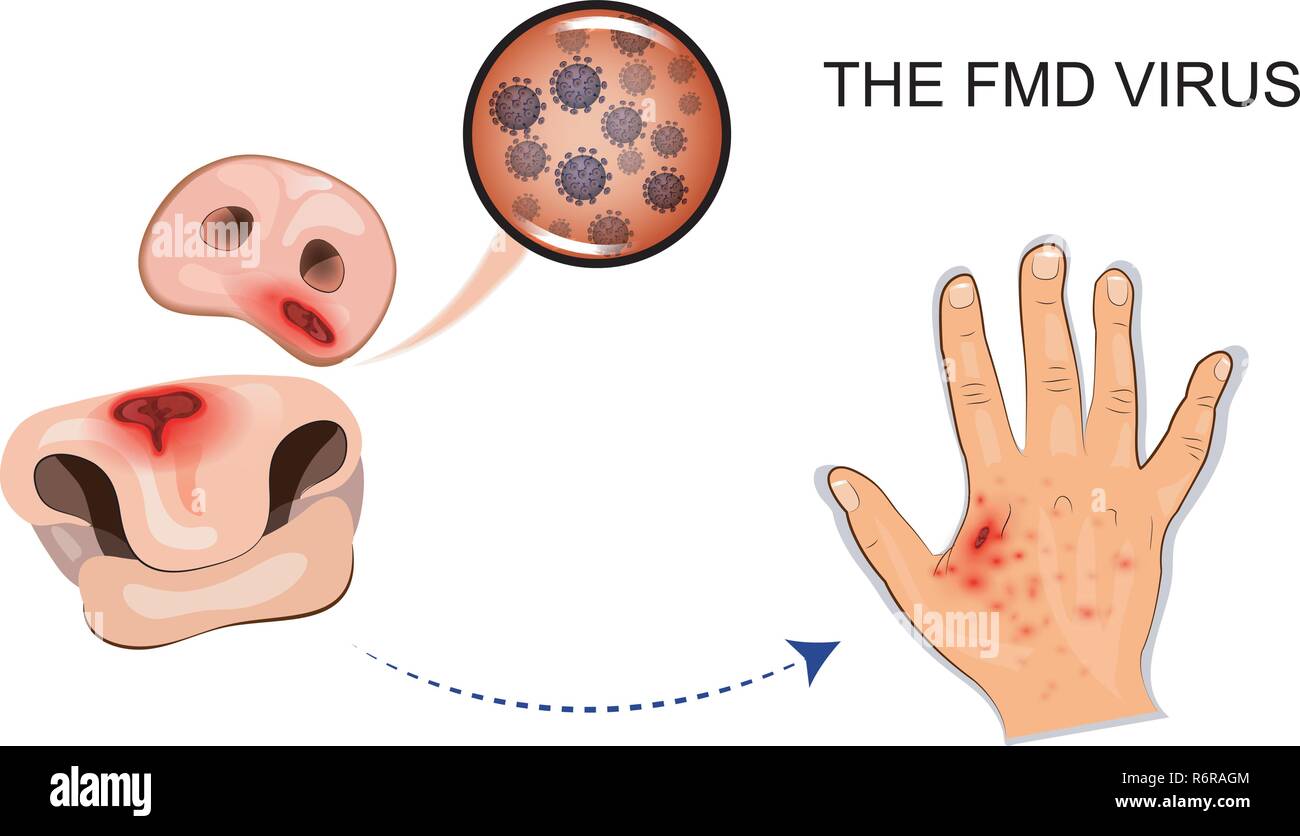 Illustrazione vettoriale di piaghe e via di trasmissione. Per pubblicazioni mediche Illustrazione Vettoriale
