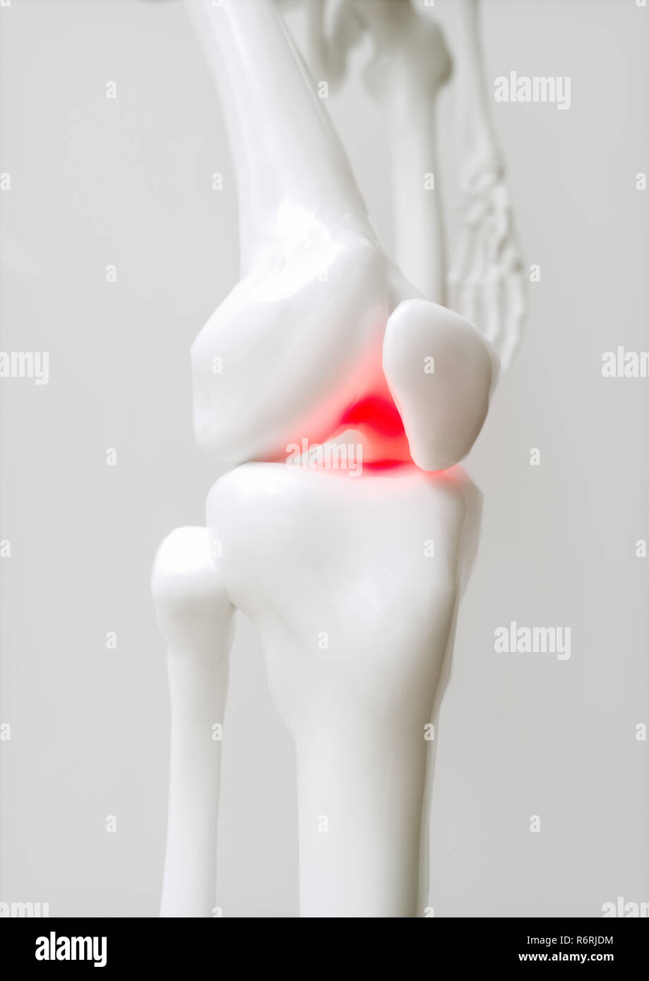 Osteoartrite del ginocchio coperto - 3D Rendering Foto Stock