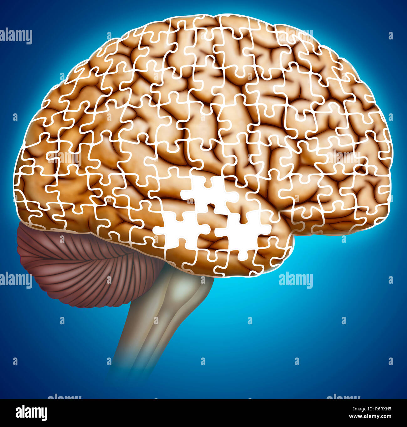 La perdita di memoria è un sintomo chiave del morbo di Alzheimer. I primi segni includono difficoltà a ricordare eventi o conversazioni recenti. Foto Stock