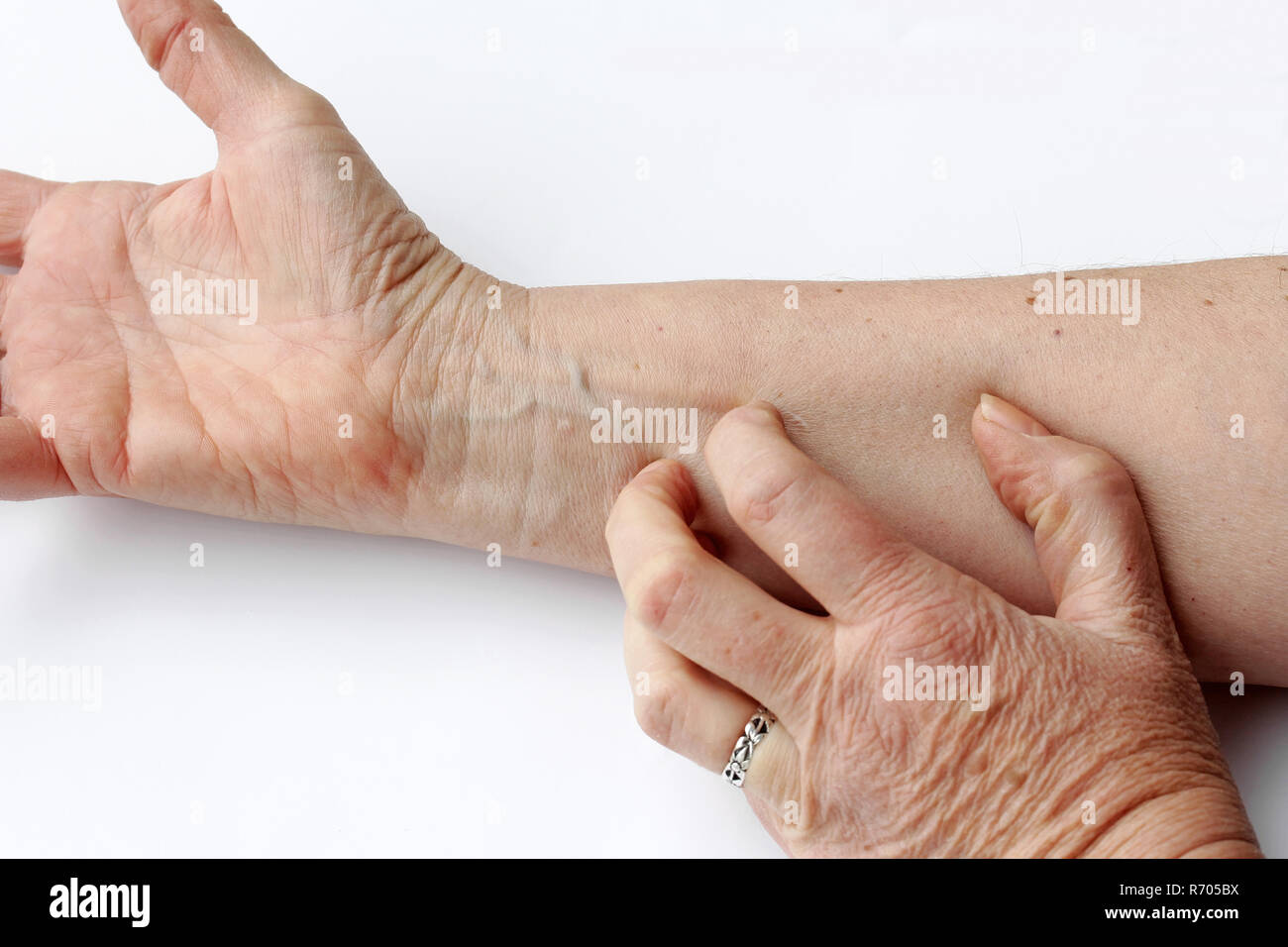 Una donna ha asciugare prurito della pelle sulla parte interna del suo  braccio Foto stock - Alamy