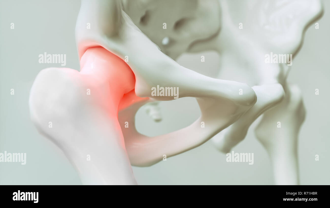 Hip dolore da artrosi - 3D Rendering Foto Stock