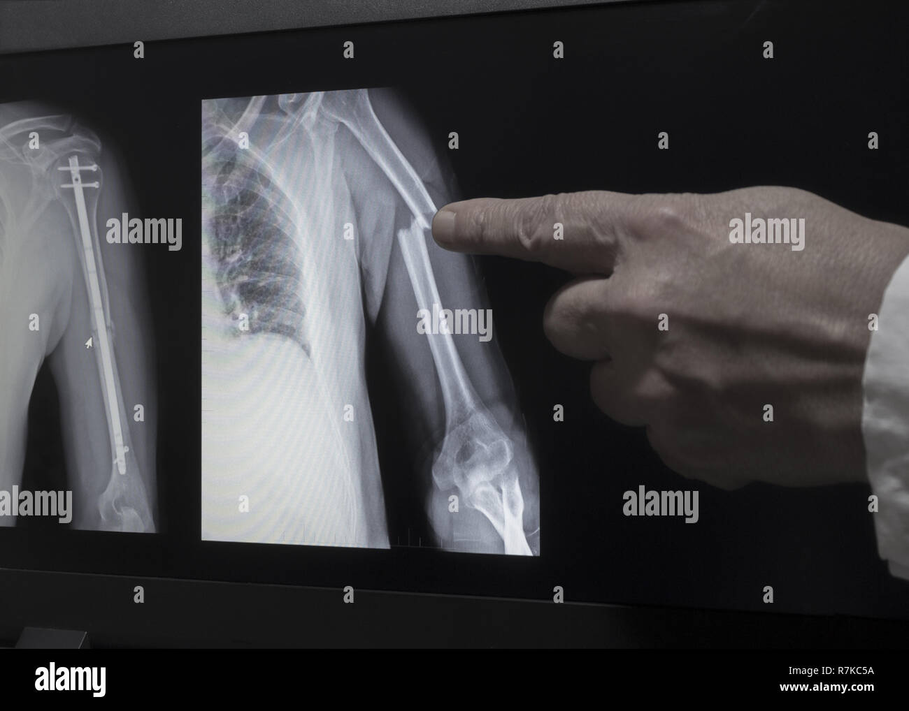 Sullo schermo del monitor è visualizzata una xray di frattura di una mano con la mano di un medico che puntano a una frattura. La seconda immagine sullo schermo è h Foto Stock