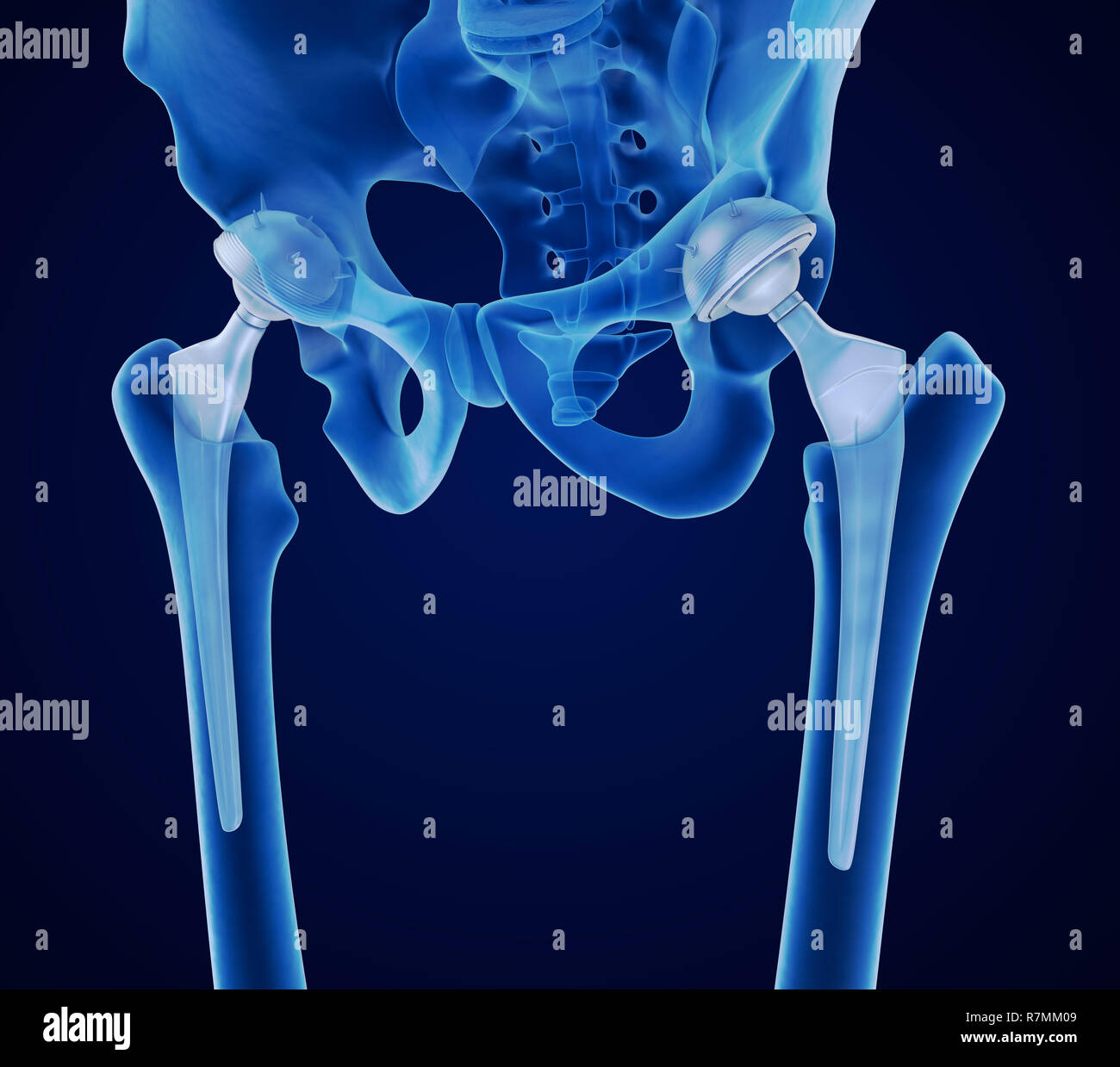 Anca sostituzione impianto installato in l'osso del bacino. Vista a raggi x. Accurata dal punto di vista medico 3D illustrazione Foto Stock