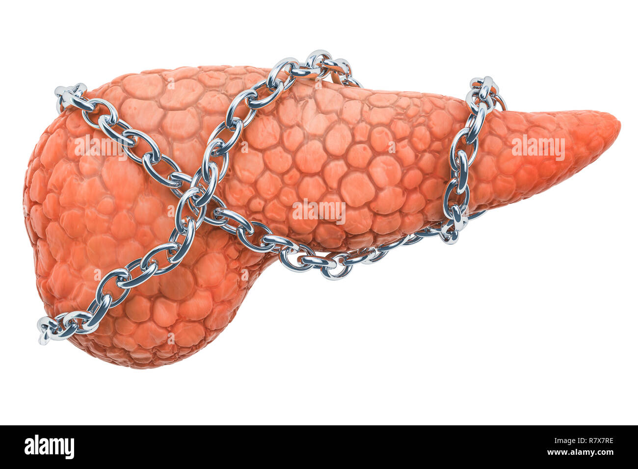 Malattia pancreatica concetto. Pancreas umano con la catena. 3D rendering isolati su sfondo bianco Foto Stock