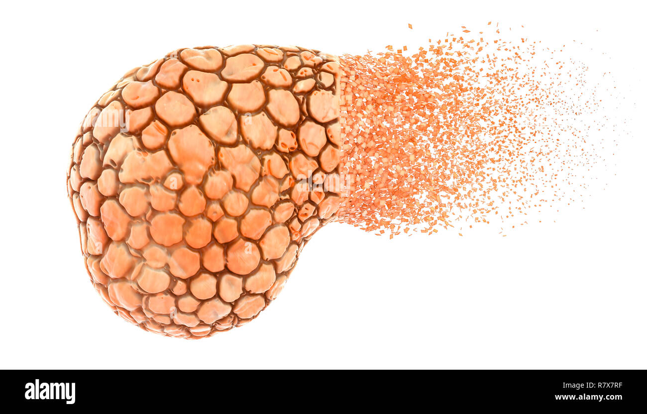 Malattia pancreatica concetto. 3D rendering isolati su sfondo bianco Foto Stock