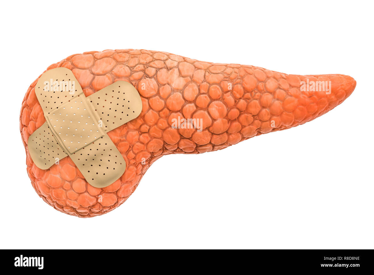 Pancreas umano con fasce adesive. Trattamento del concetto pancreatica, rendering 3D isolati su sfondo bianco Foto Stock