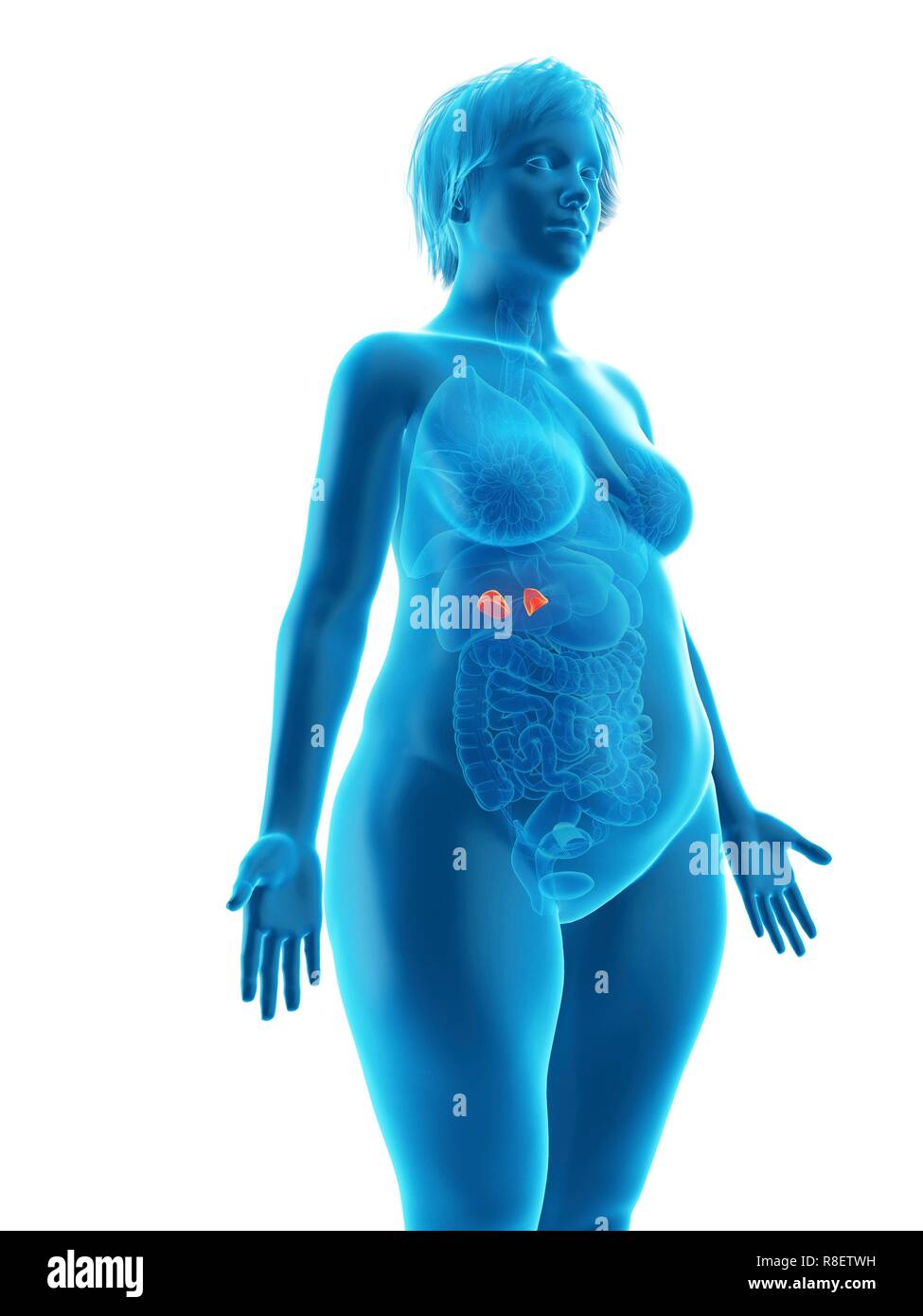 Illustrazione di una donna obesa di ghiandole surrenali. Foto Stock