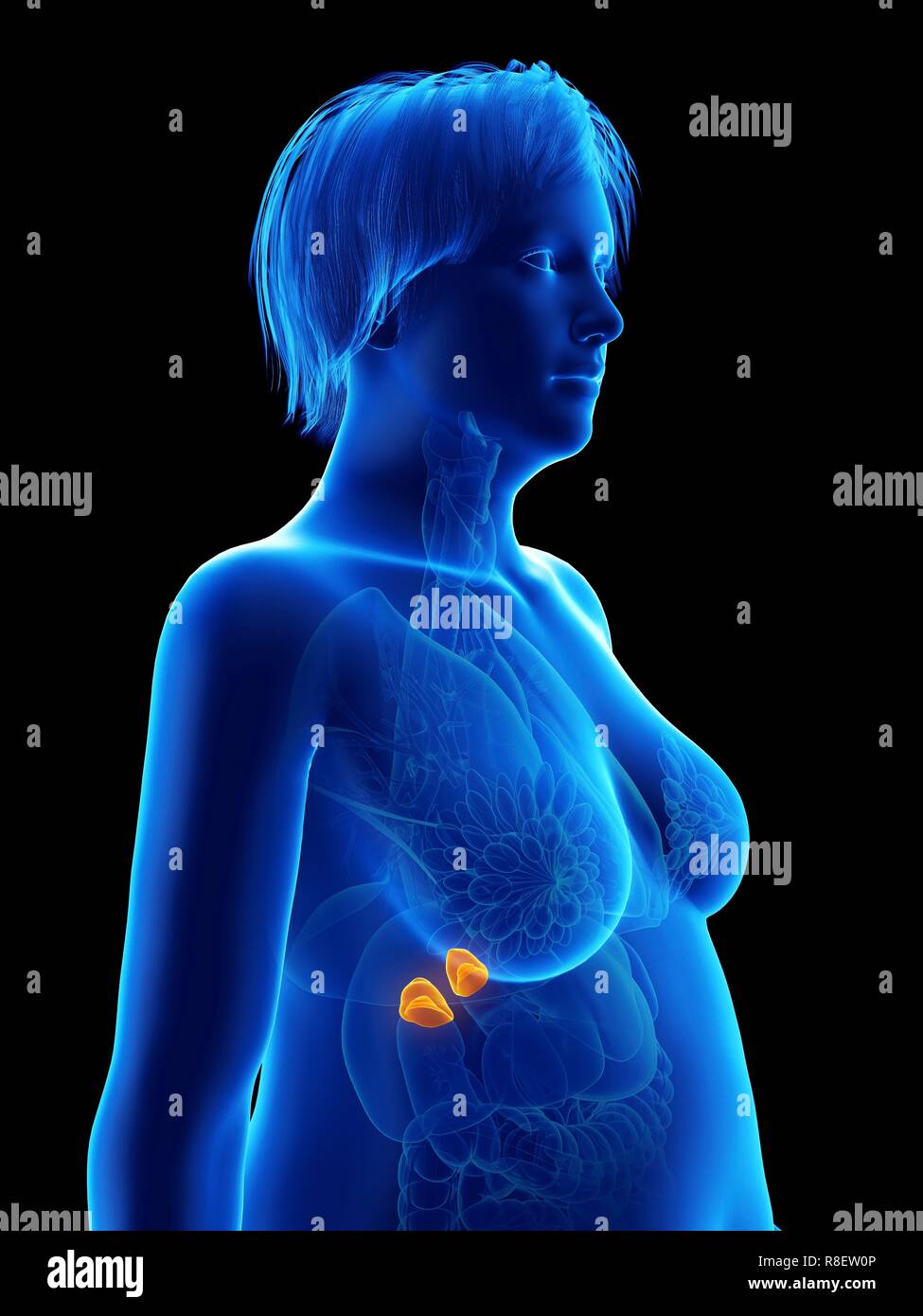 Illustrazione di una donna obesa di ghiandole surrenali. Foto Stock