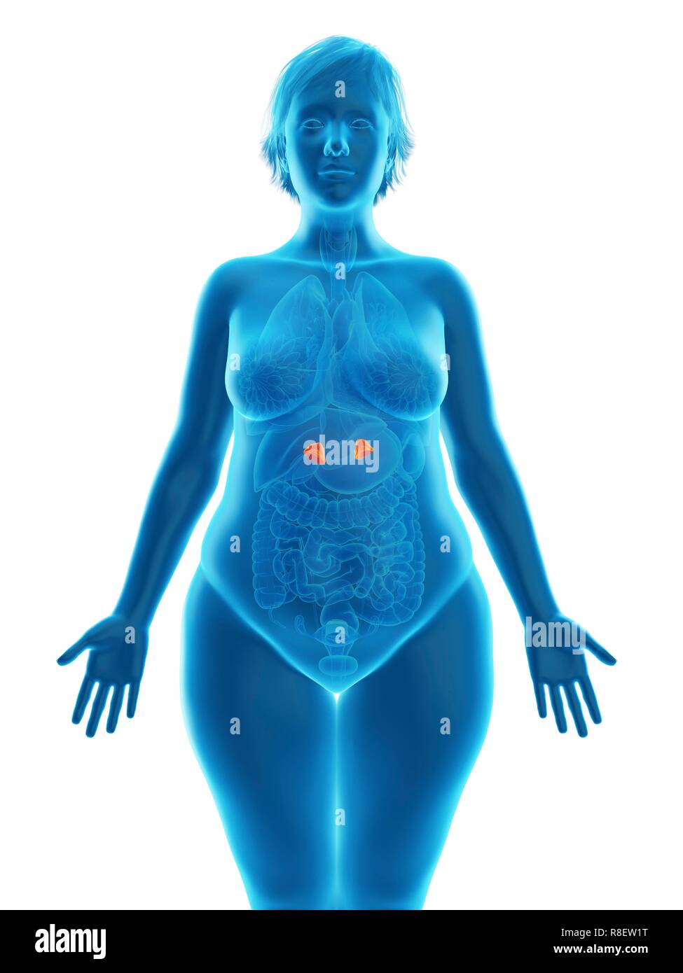 Illustrazione di una donna obesa di ghiandole surrenali. Foto Stock