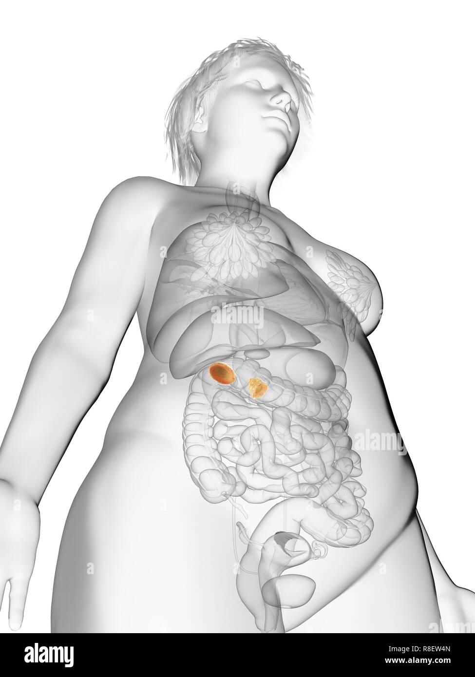 Illustrazione di una donna obesa di ghiandole surrenali. Foto Stock