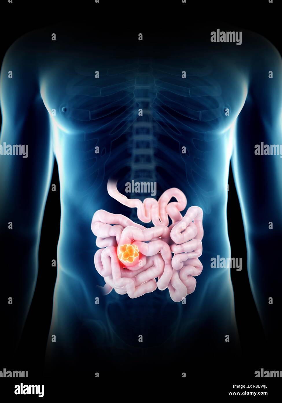 Illustrazione di un uomo del piccolo intestino tumore. Foto Stock