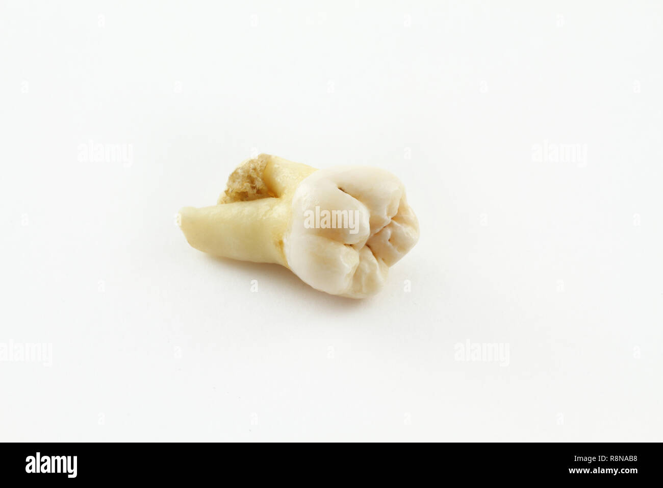 Ottavo dente inferiore rimossa insieme con un pezzo di tessuto osseo su carta. Dente di saggezza Foto Stock