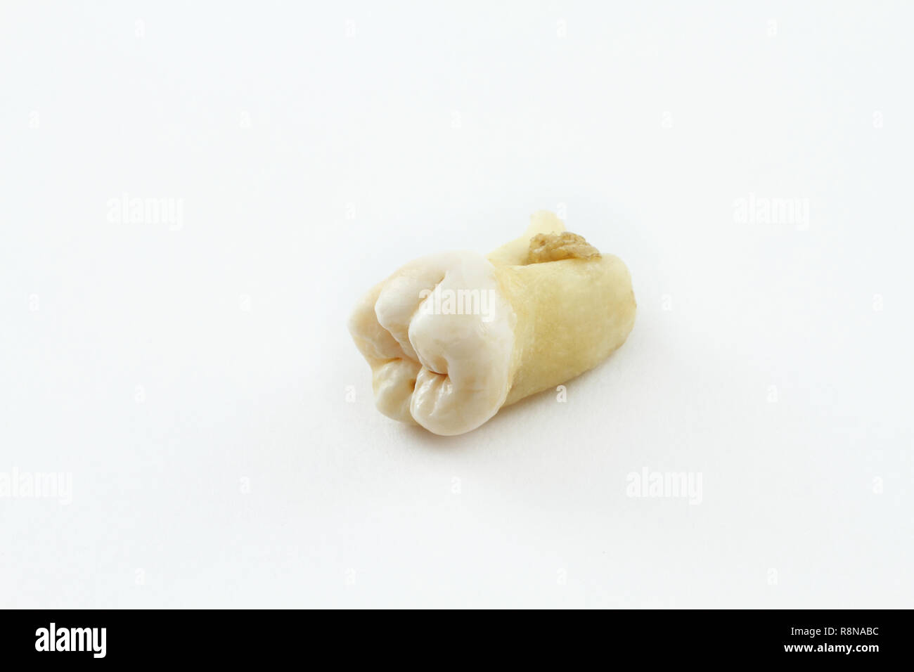 Ottavo dente inferiore rimossa insieme con un pezzo di tessuto osseo su carta. Dente di saggezza Foto Stock