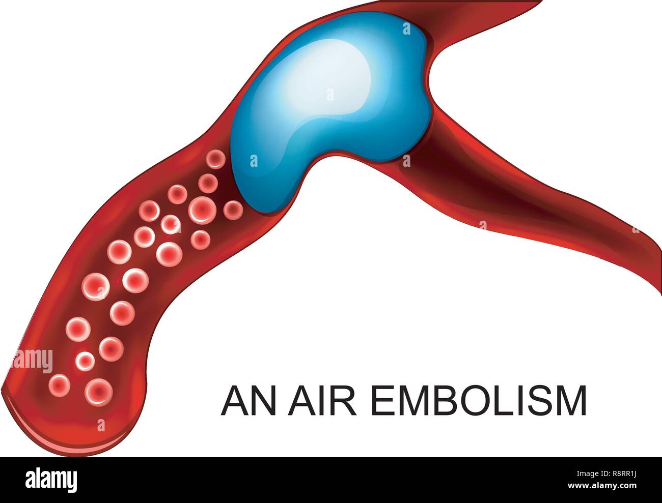 Illustrazione vettoriale di embolia di aria del vaso sanguigno Illustrazione Vettoriale
