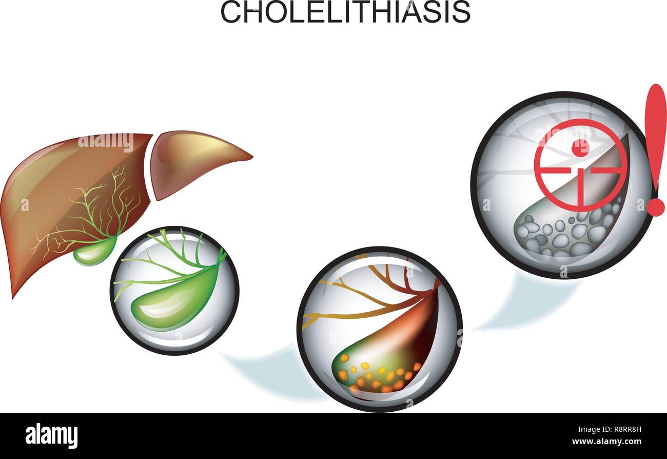 Illustrazione della malattia gallstone. dolore e sintomi Illustrazione Vettoriale