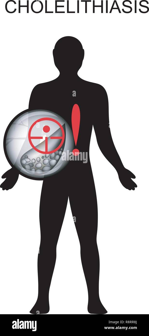 Illustrazione della malattia gallstone. dolore e sintomi Illustrazione Vettoriale
