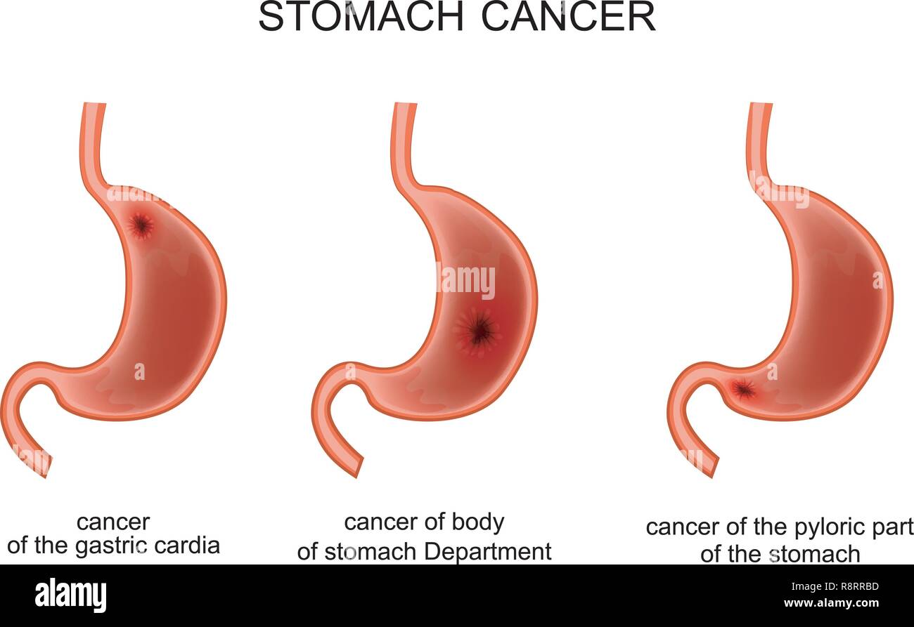 Illustrazione vettoriale di una malattia cancerosa dello stomaco Illustrazione Vettoriale