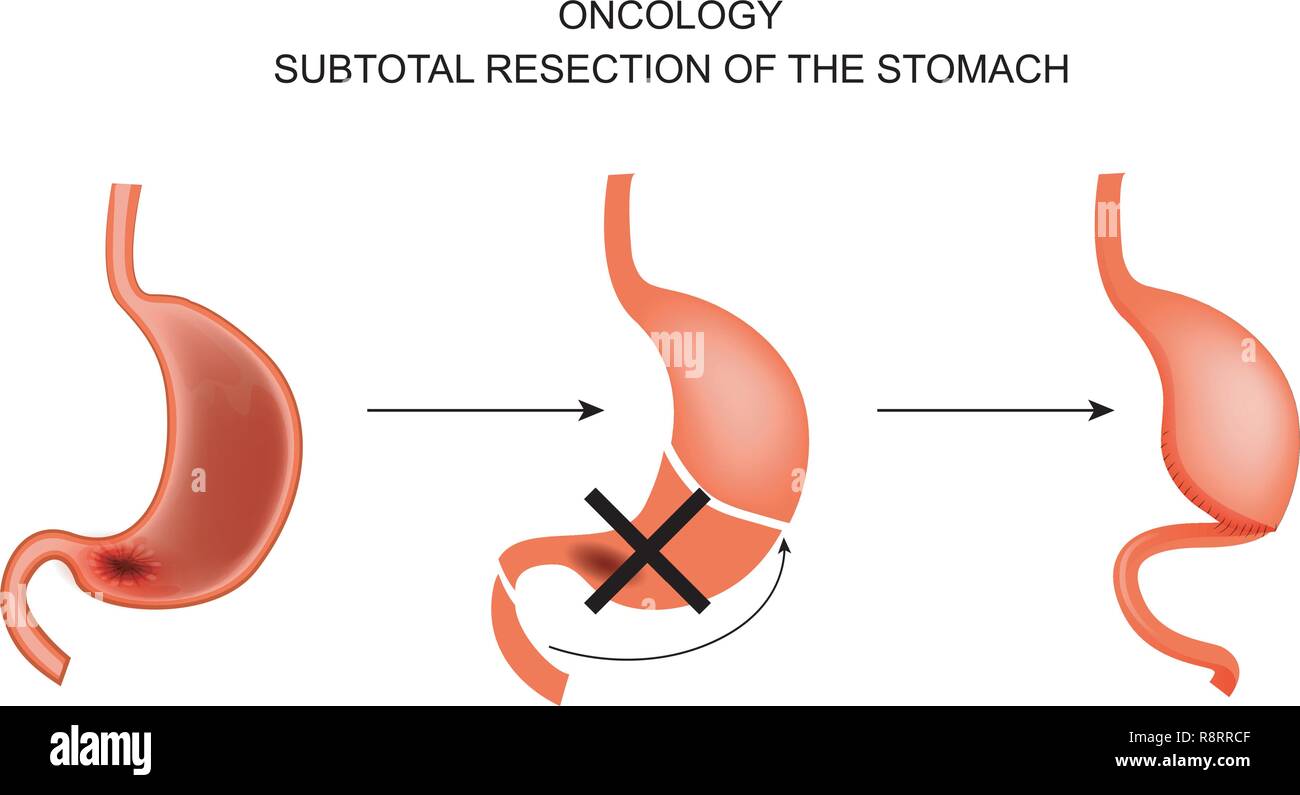 Illustrazione vettoriale di un subtotale gastrectomia per cancro dello stomaco. Illustrazione Vettoriale