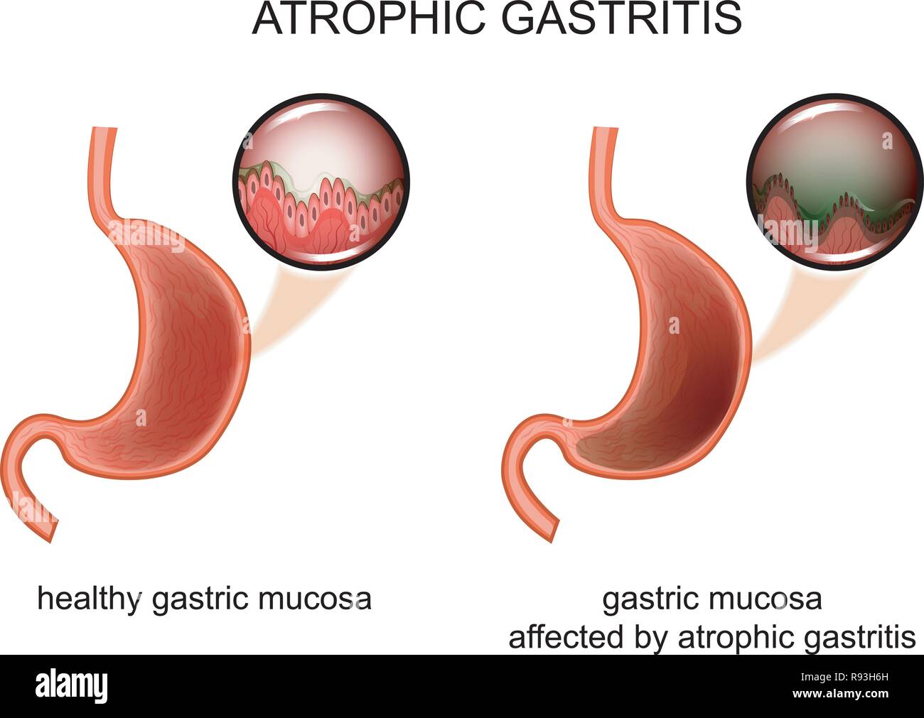 Illustrazione vettoriale di gastrite atrofica. infiammazione della mucosa. Illustrazione Vettoriale