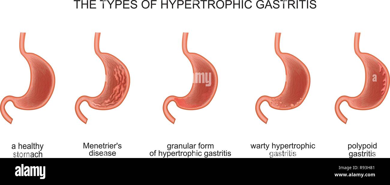 Illustrazione Vettoriale dei tipi di gastrite ipertrofica Illustrazione Vettoriale
