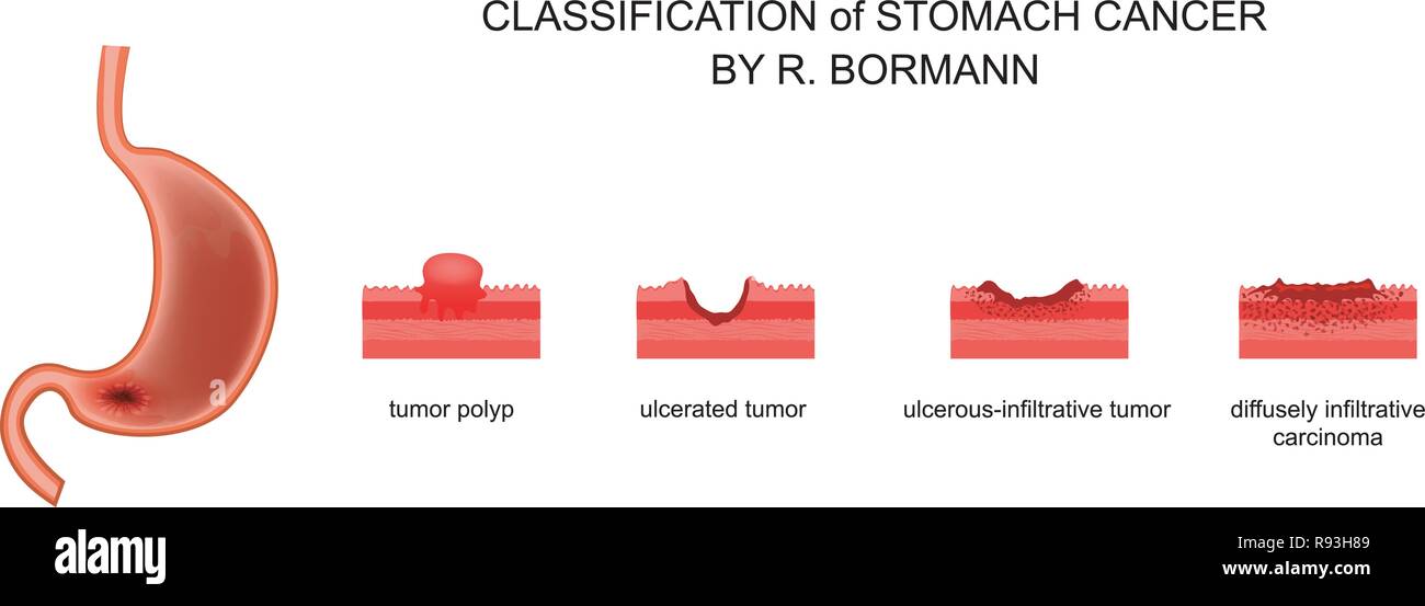 Illustrazione vettoriale di classificazione del cancro gastrico Illustrazione Vettoriale