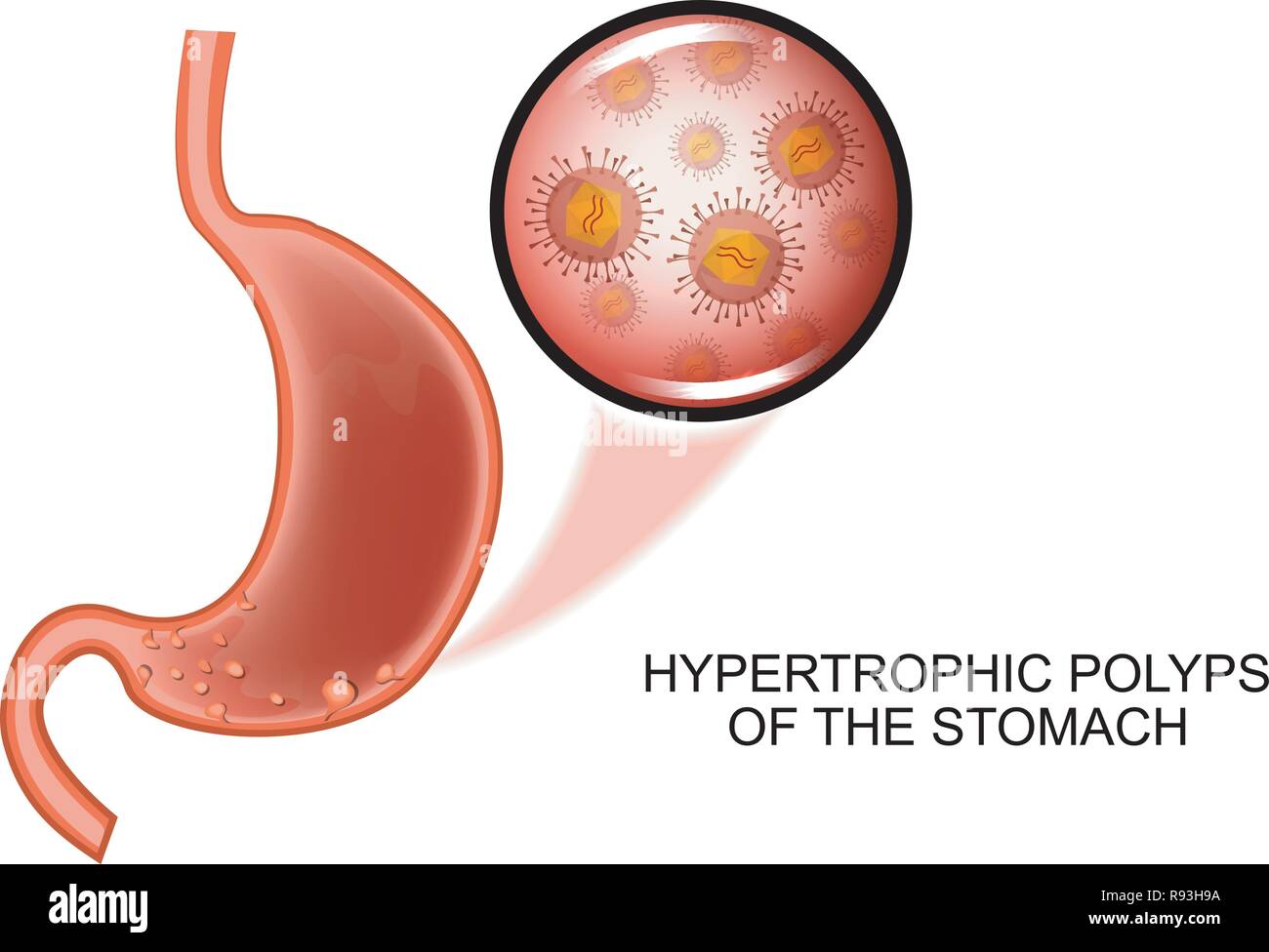 Illustrazione vettoriale di poliposi ipertrofica dello stomaco Illustrazione Vettoriale
