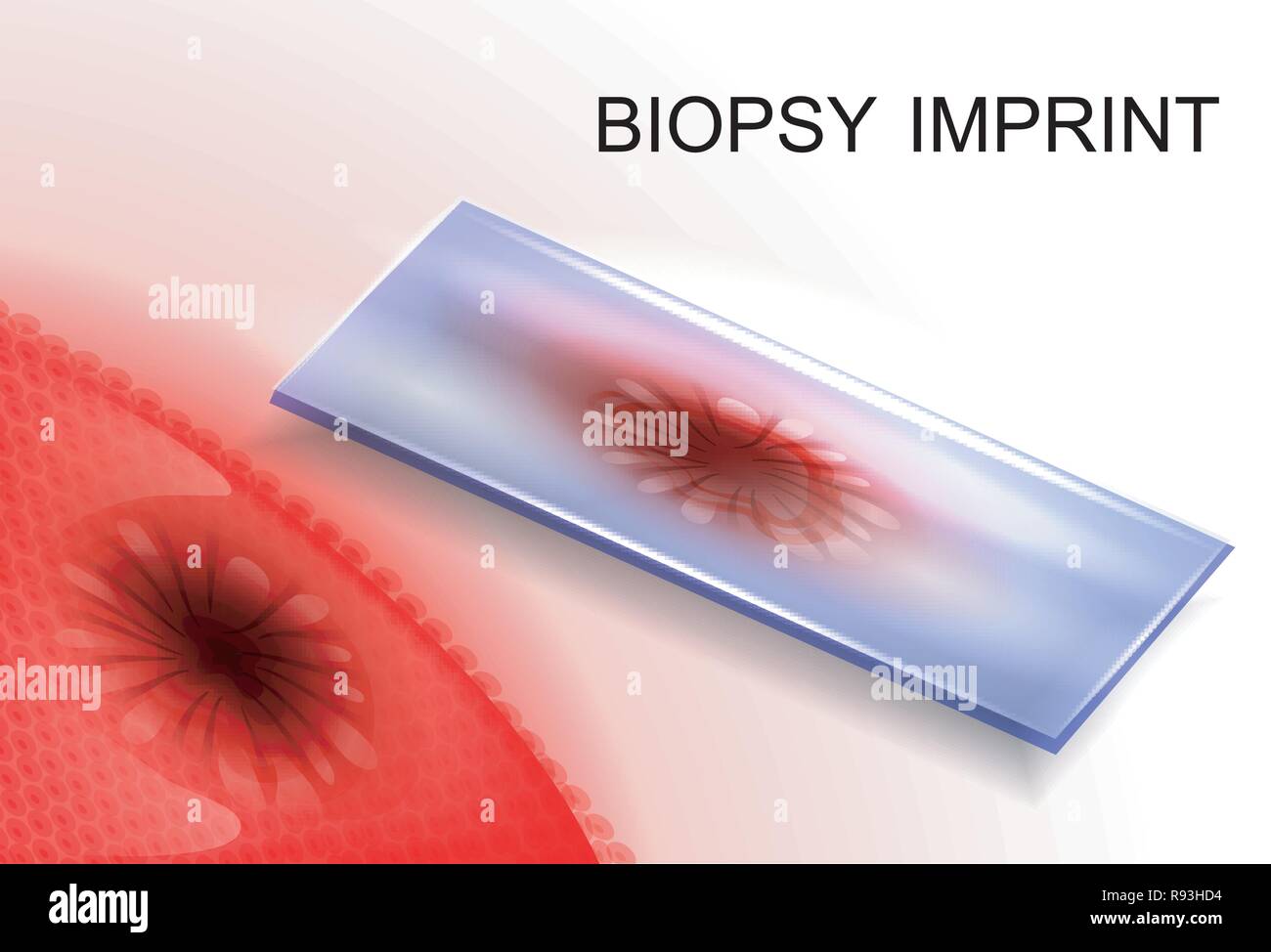 Illustrazione vettoriale di una biopsia imprint.la diagnosi del cancro Illustrazione Vettoriale