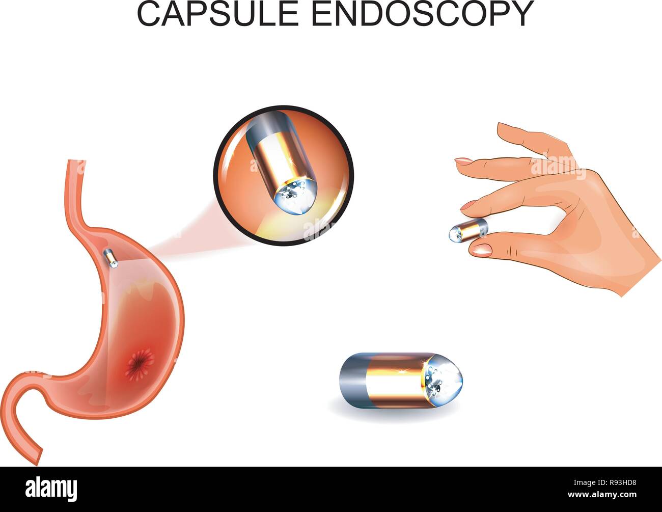 Illustrazione vettoriale della capsula endoscopia. EGD, Gastroenterology. Illustrazione Vettoriale