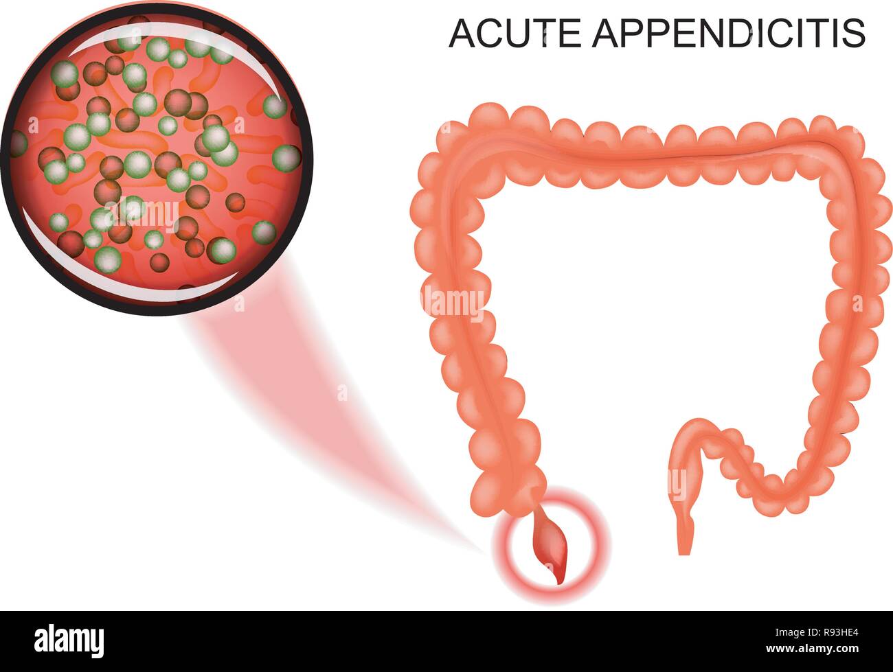 Illustrazione vettoriale di appendicite acuta. batteri, infiammazione Illustrazione Vettoriale