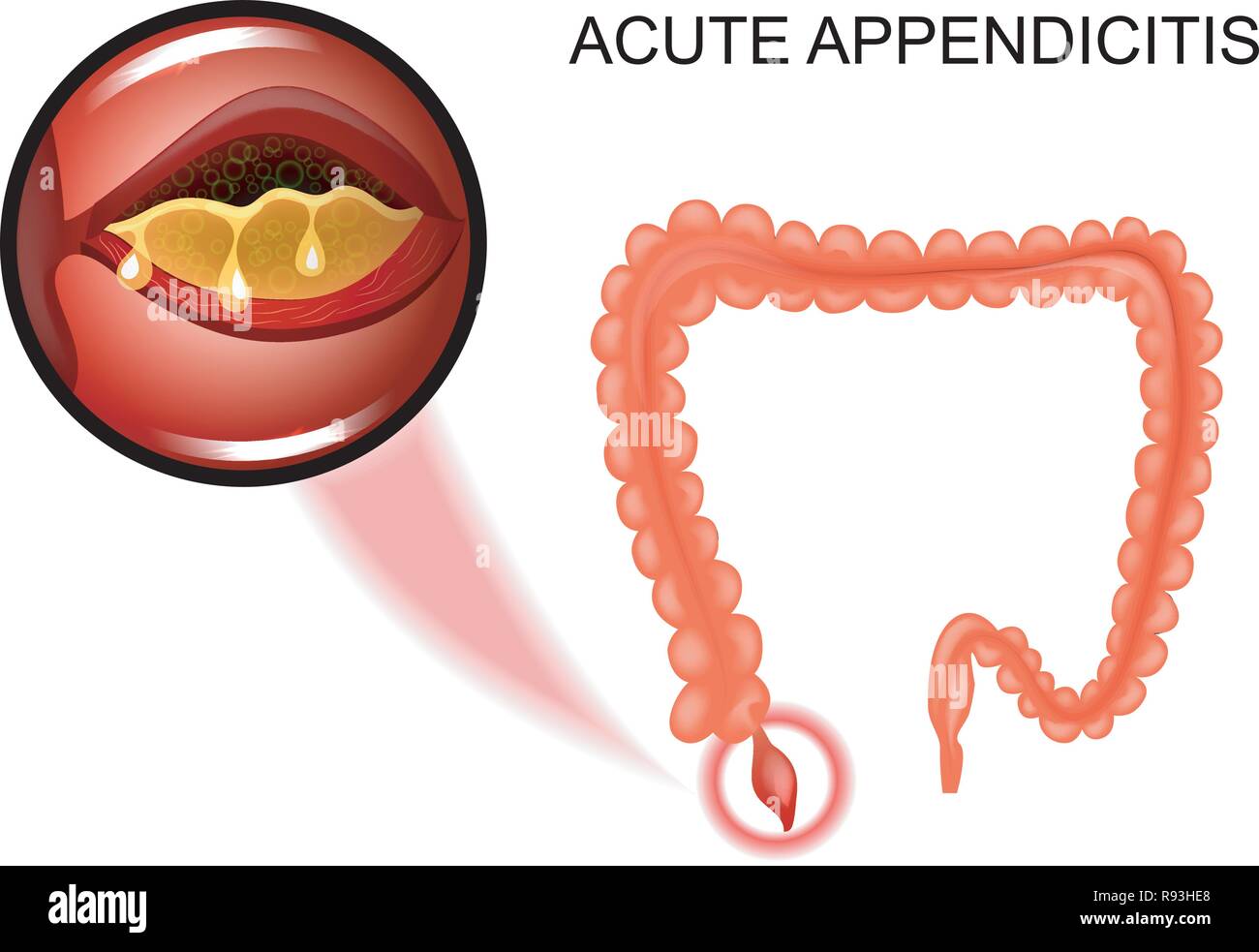 Illustrazione vettoriale di appendicite acuta, l'infiammazione dell'Appendice Illustrazione Vettoriale
