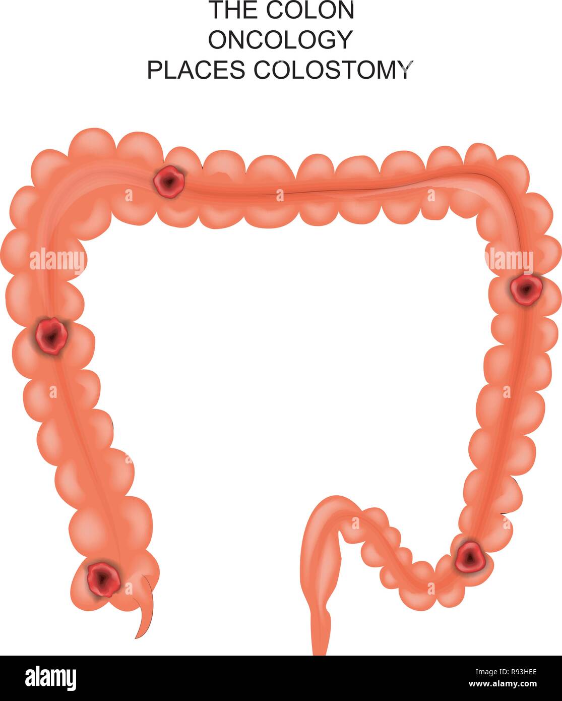 Illustrazione vettoriale di una colostomia. luogo di intervento chirurgico Illustrazione Vettoriale