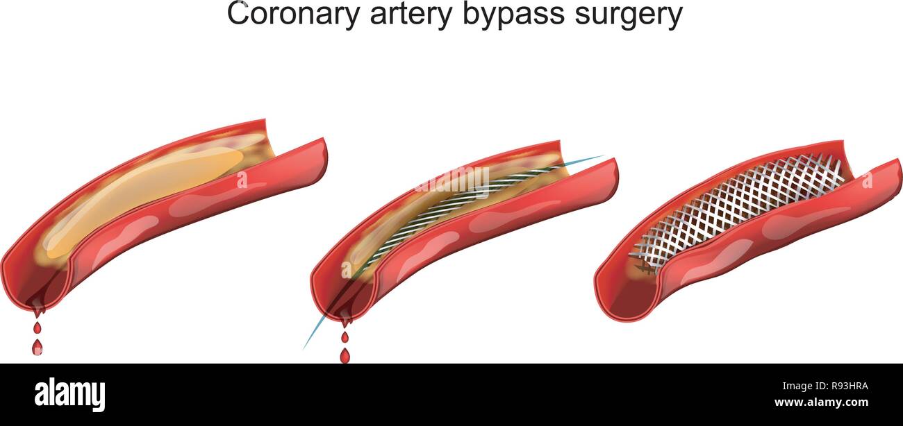 Illustrazione vettoriale di bypass di arteria coronaria navi Illustrazione Vettoriale