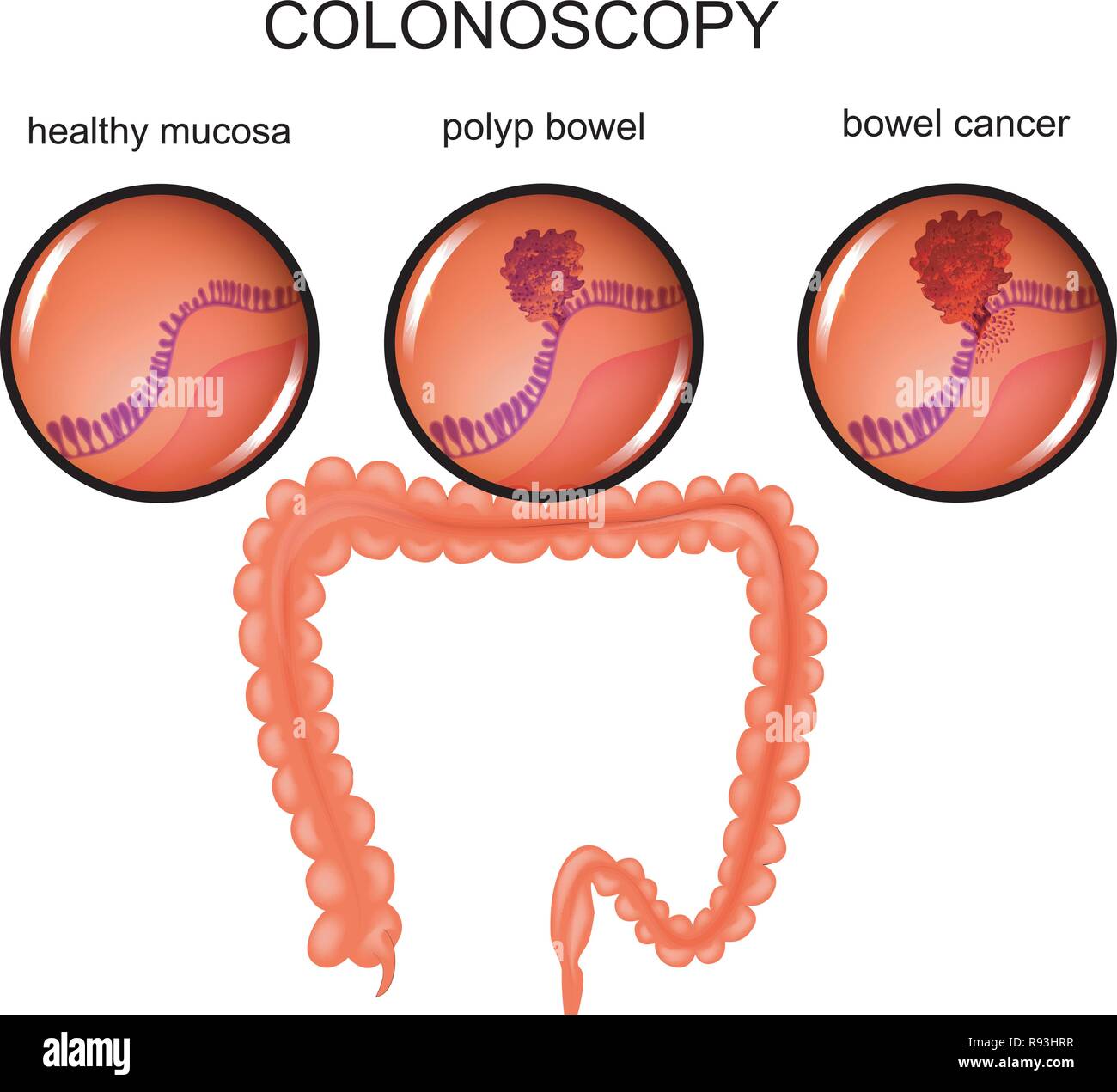 Illustrazione vettoriale di un polipo del colon e cancro Illustrazione Vettoriale