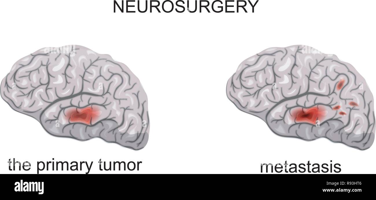 Illustrazione vettoriale di un tumore al cervello. metastasi. neurochirurgia Illustrazione Vettoriale