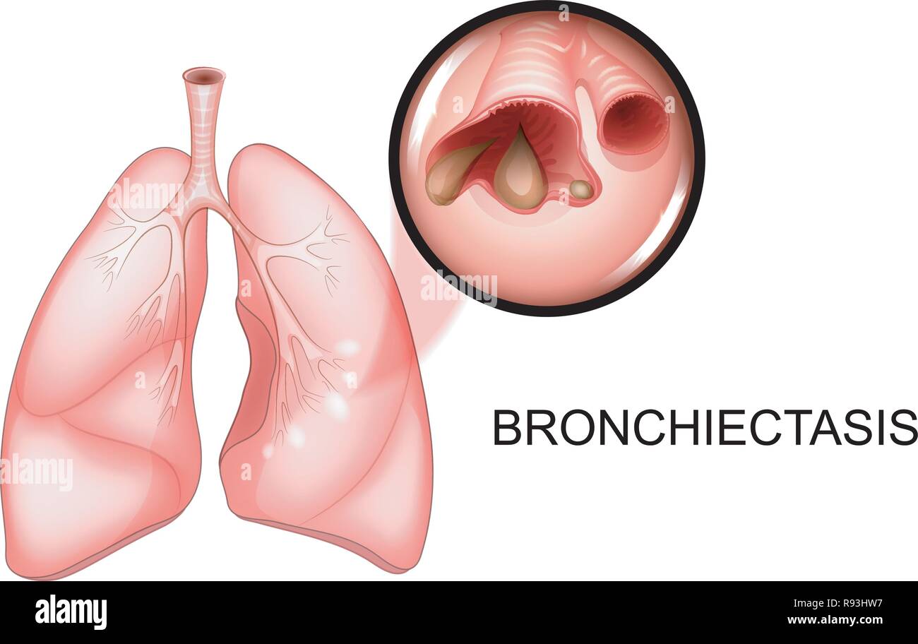 Illustrazione vettoriale di polmoni colpiti dalla malattia broncoectasia Illustrazione Vettoriale