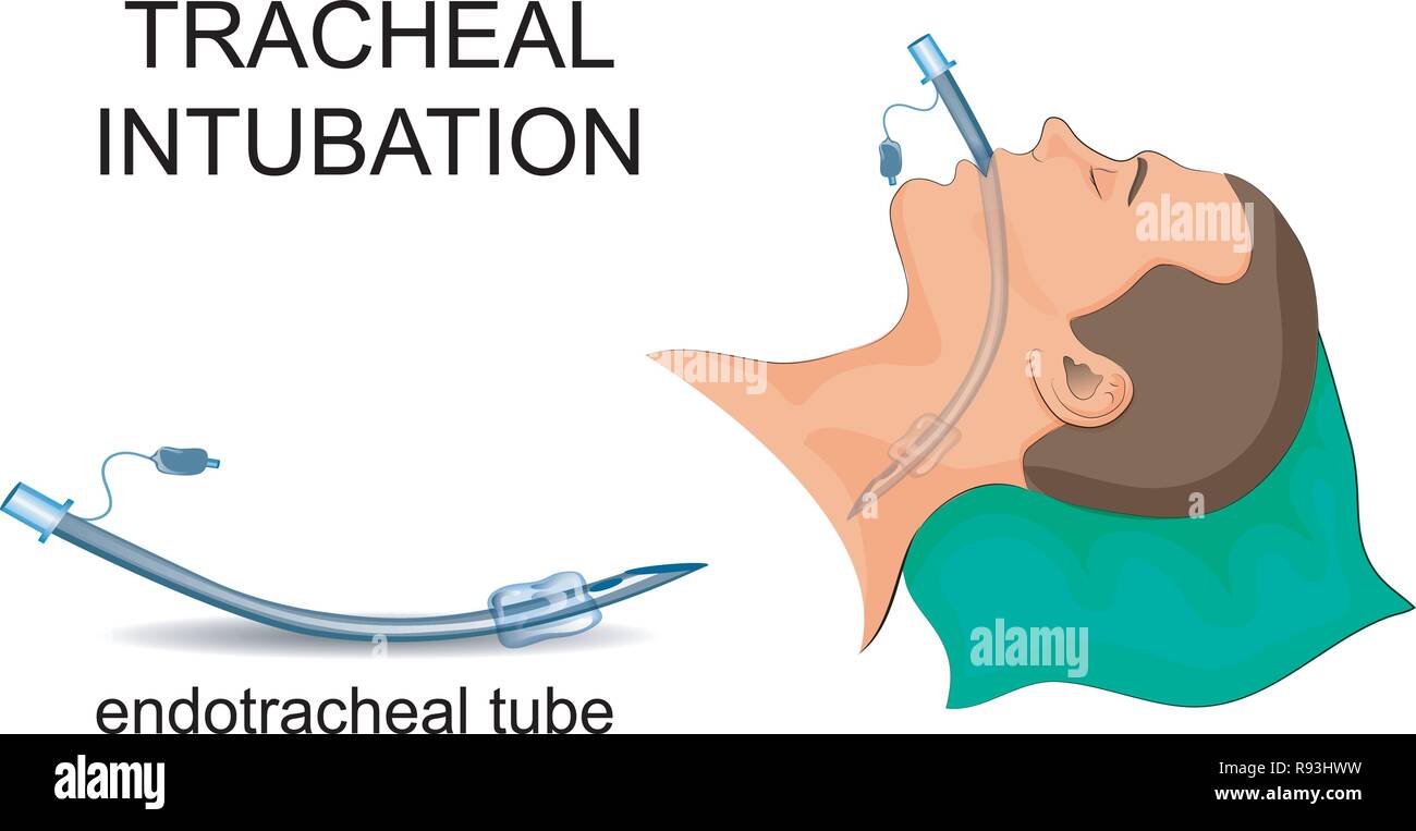 Illustrazione vettoriale di intubazione tracheale. ventilazione artificiale dei polmoni Illustrazione Vettoriale