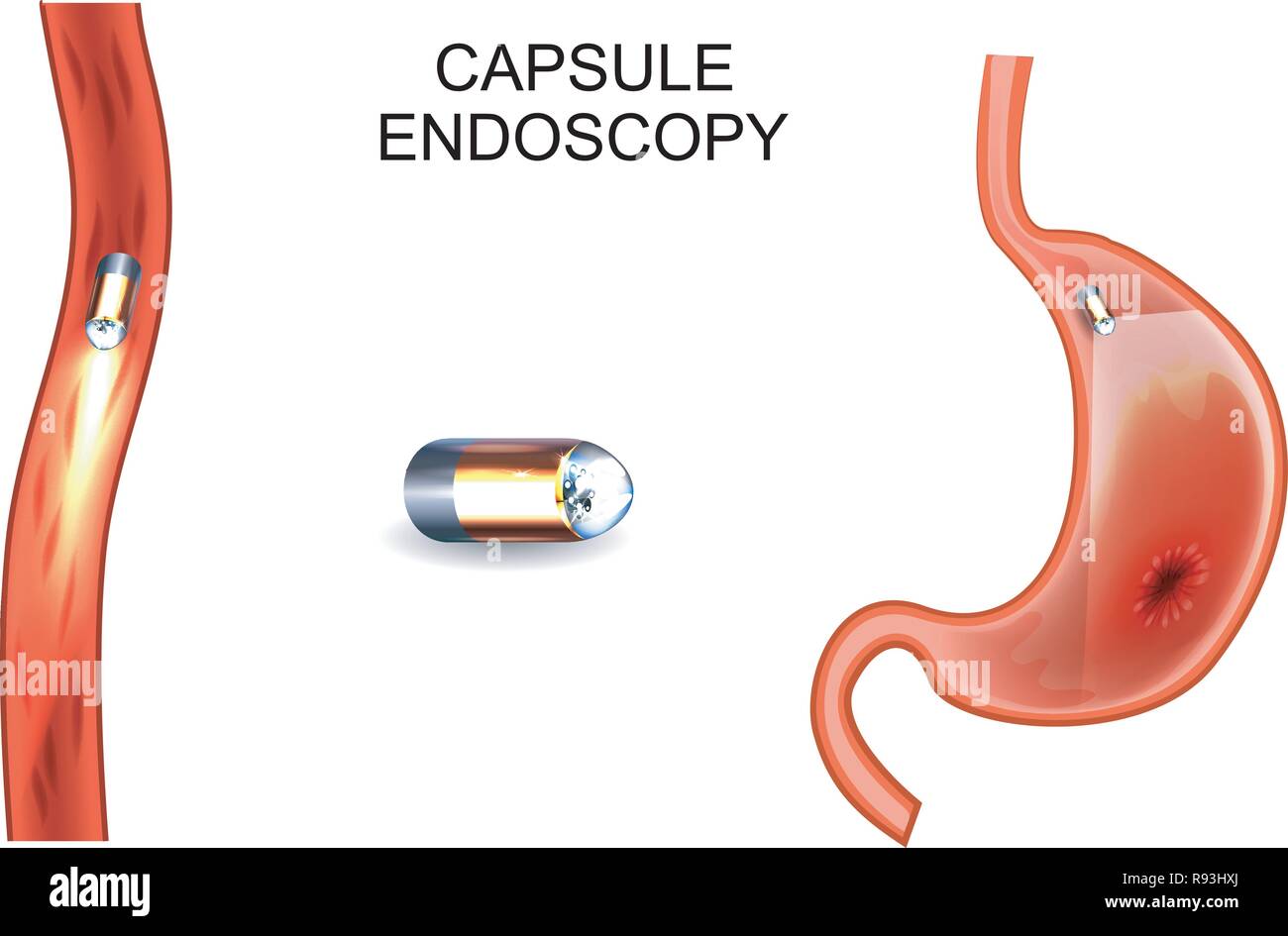 Illustrazione vettoriale della capsula endoscopia. EGD, Gastroenterology. Illustrazione Vettoriale