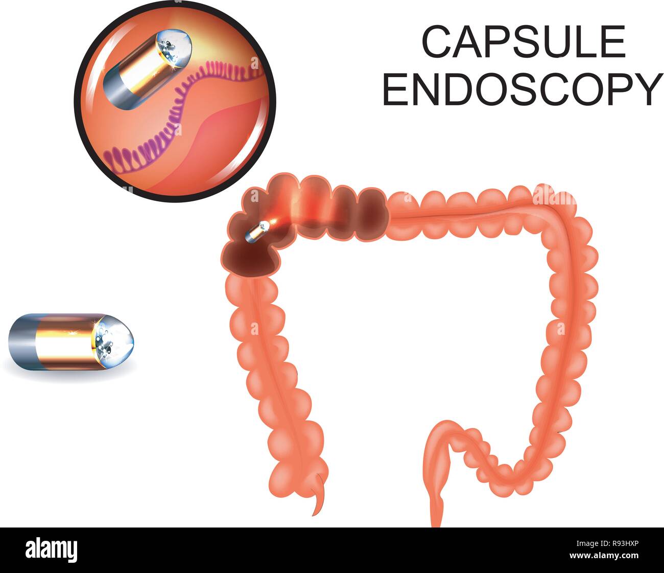 Illustrazione vettoriale della capsula endoscopia del colon Illustrazione Vettoriale