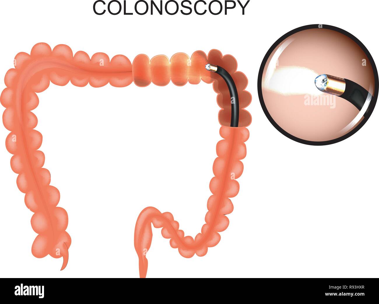 Illustrazione vettoriale di intestino crasso, colonoscop medicina. Illustrazione Vettoriale