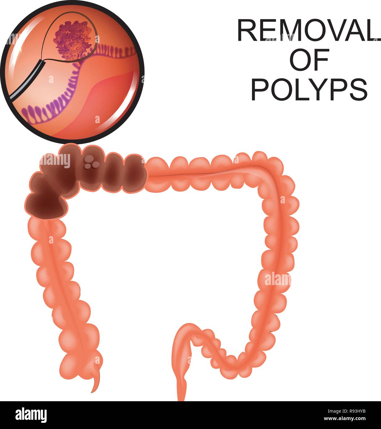 Illustrazione vettoriale di polipi nel colon. Distacco dei polipi Illustrazione Vettoriale