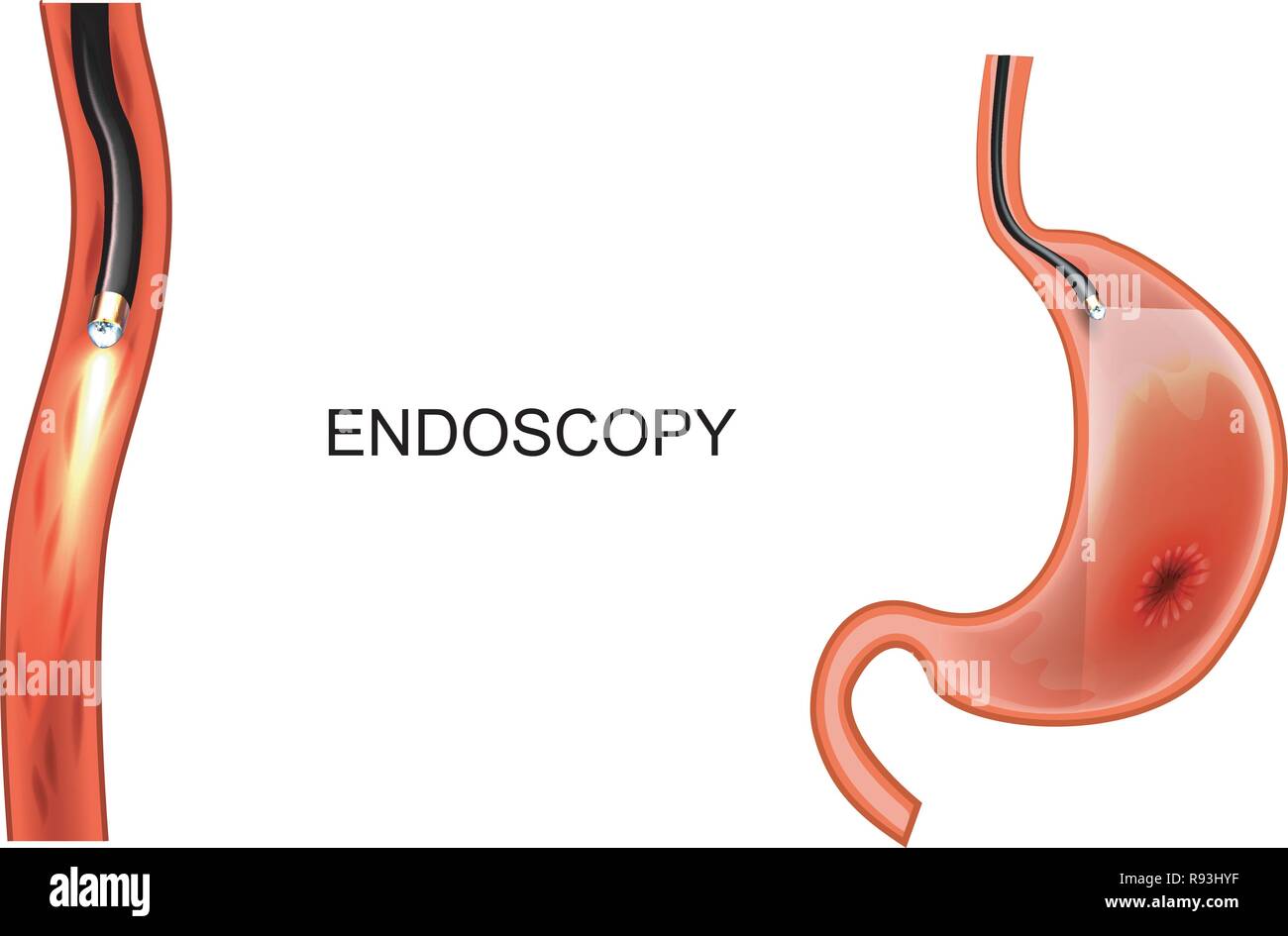 Illustrazione vettoriale di una endoscopia dello stomaco. EGD. ulcera, cancro Illustrazione Vettoriale