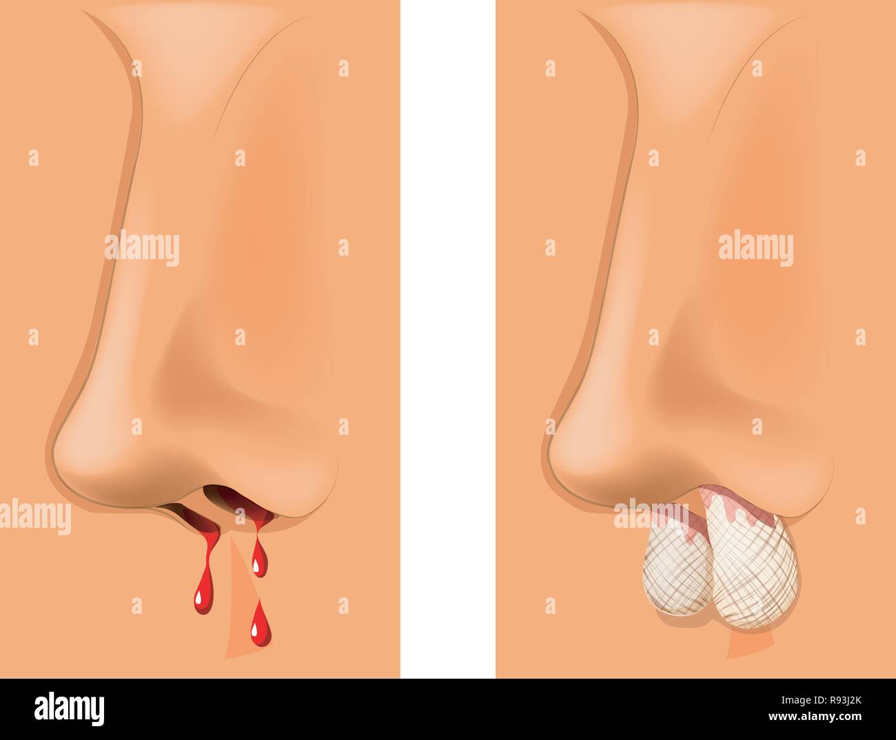 Illustrazione vettoriale di sanguinamento nasale, di tamponamento del naso. Illustrazione Vettoriale