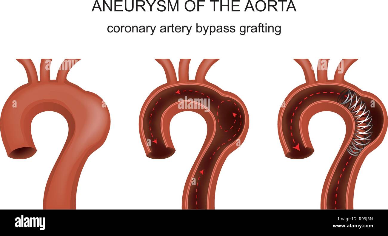 Illustrazione vettoriale di innesto di bypass arterioso coronarico Illustrazione Vettoriale