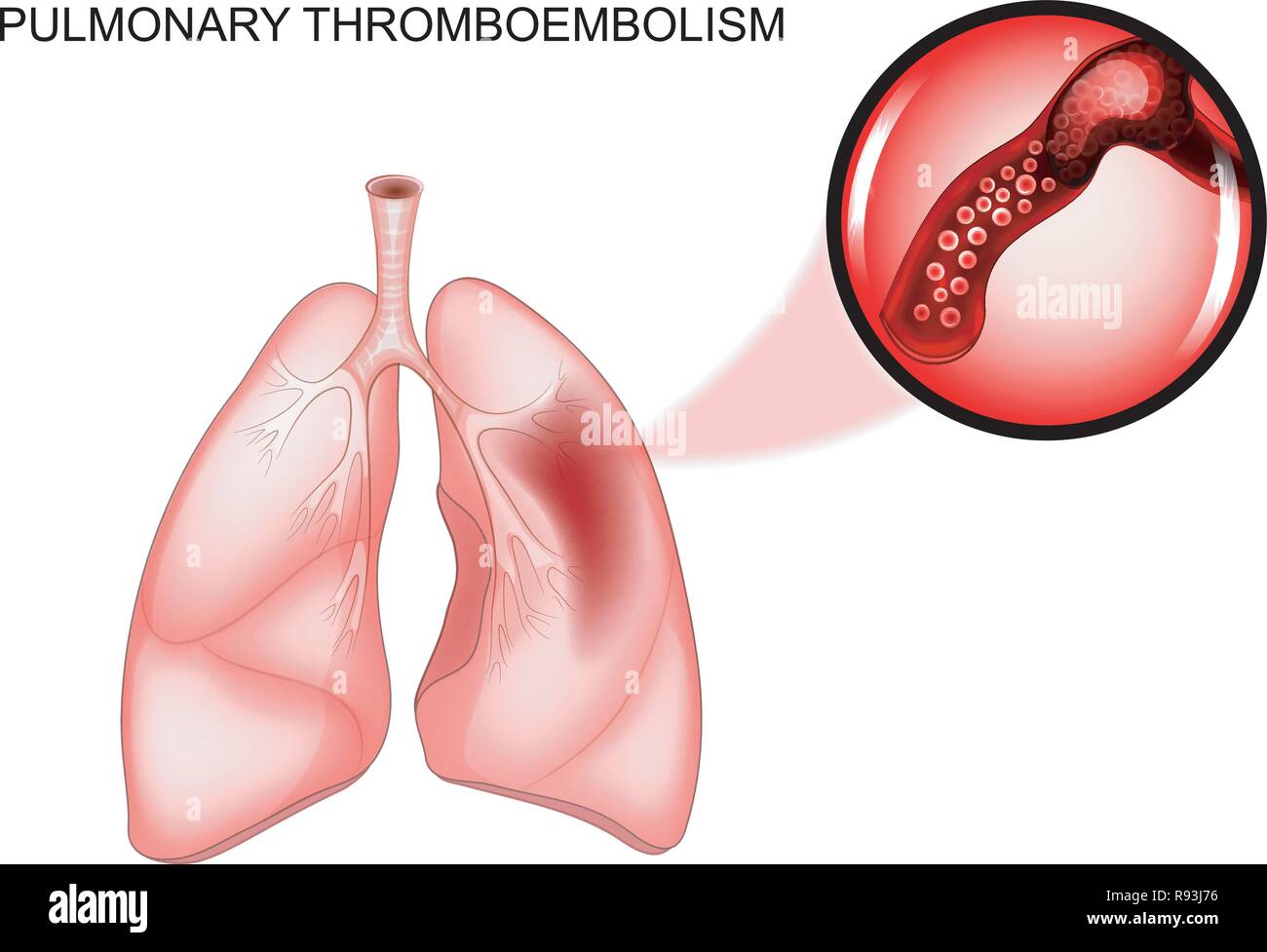 Illustrazione vettoriale di tromboembolia polmonare. trombosi della nave Illustrazione Vettoriale