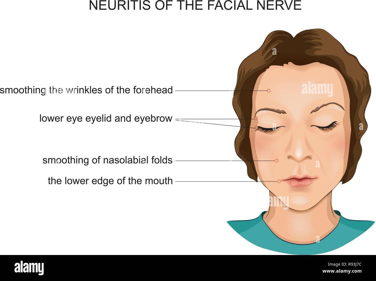 Illustrazione vettoriale di neurite del nervo facciale Illustrazione Vettoriale