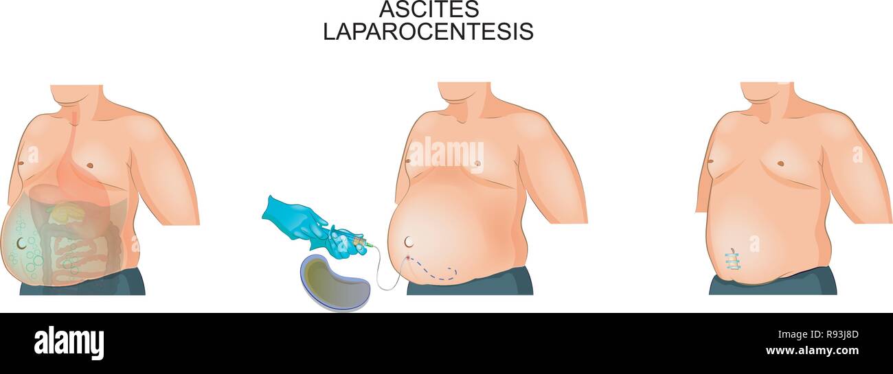 Illustrazione vettoriale di un uomo che soffre di ascite. Laparocentesis Illustrazione Vettoriale