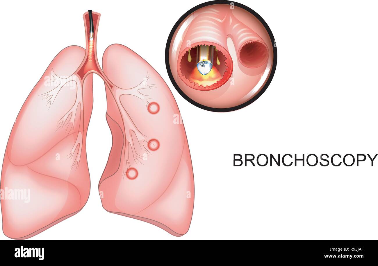 Illustrazione vettoriale di una broncoscopia dei polmoni, vista in sezione Illustrazione Vettoriale
