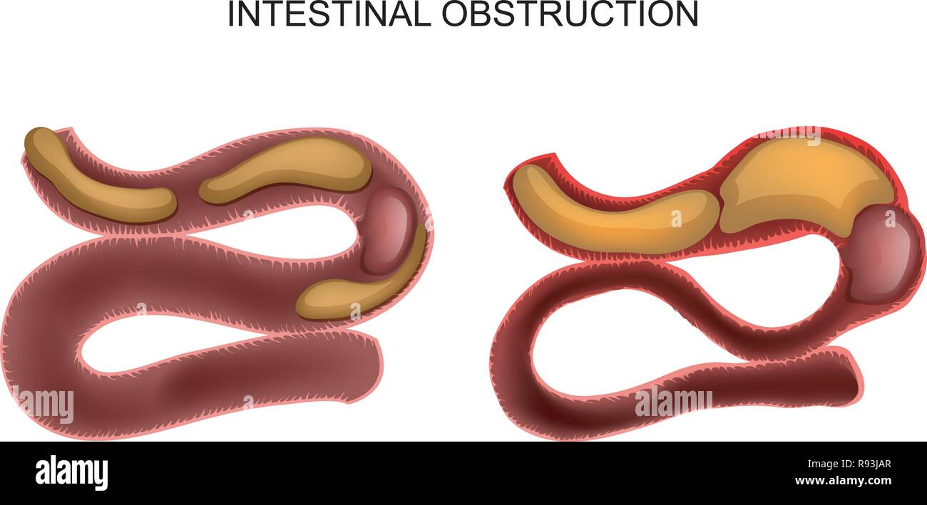 Illustrazione vettoriale di occlusione intestinale a causa di un tumore canceroso Illustrazione Vettoriale